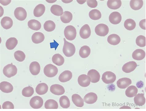 tear cells blood test|tear cell morphology.